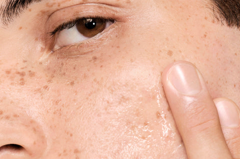Oily Skin
