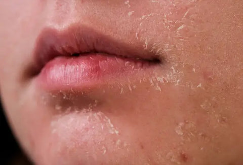 Dryness