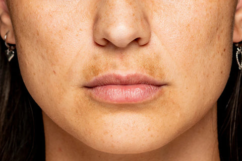 Uneven Skin Tone